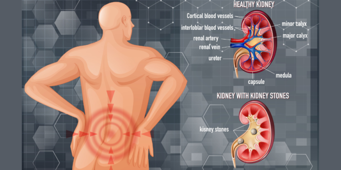 Kidney Stones: Symptoms, Causes, Types, Treatment & Home Remedies